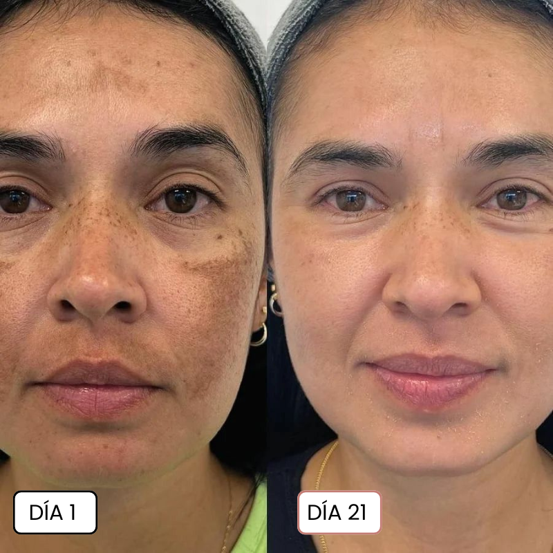 Elimina tus Manchas y tu Paño en 21 Días para Siempre con Clinavé | 1+1 SOLO HOY